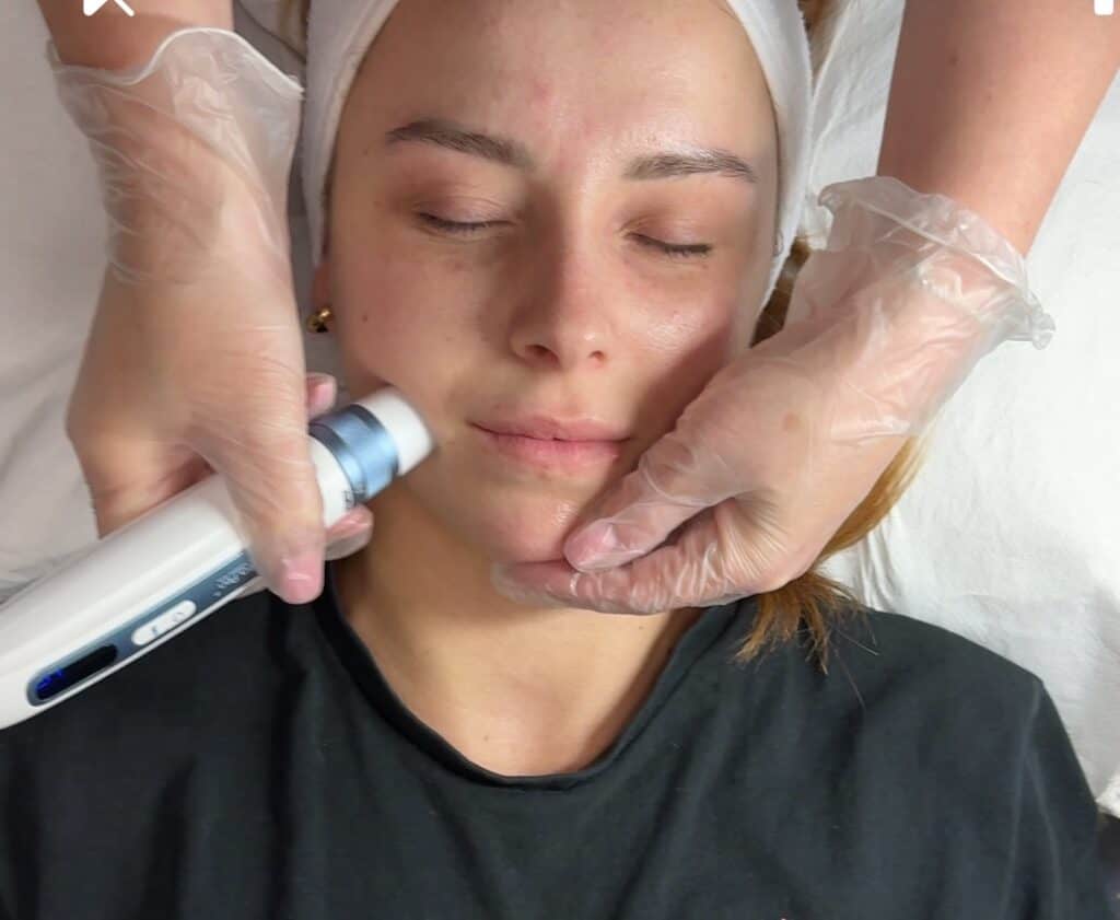 The Benefits of Microneedling & Why We Use LED Light Therapy for Best Results – IMG_2081